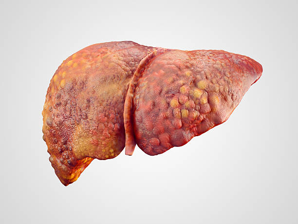 Cirrhosis of Liver